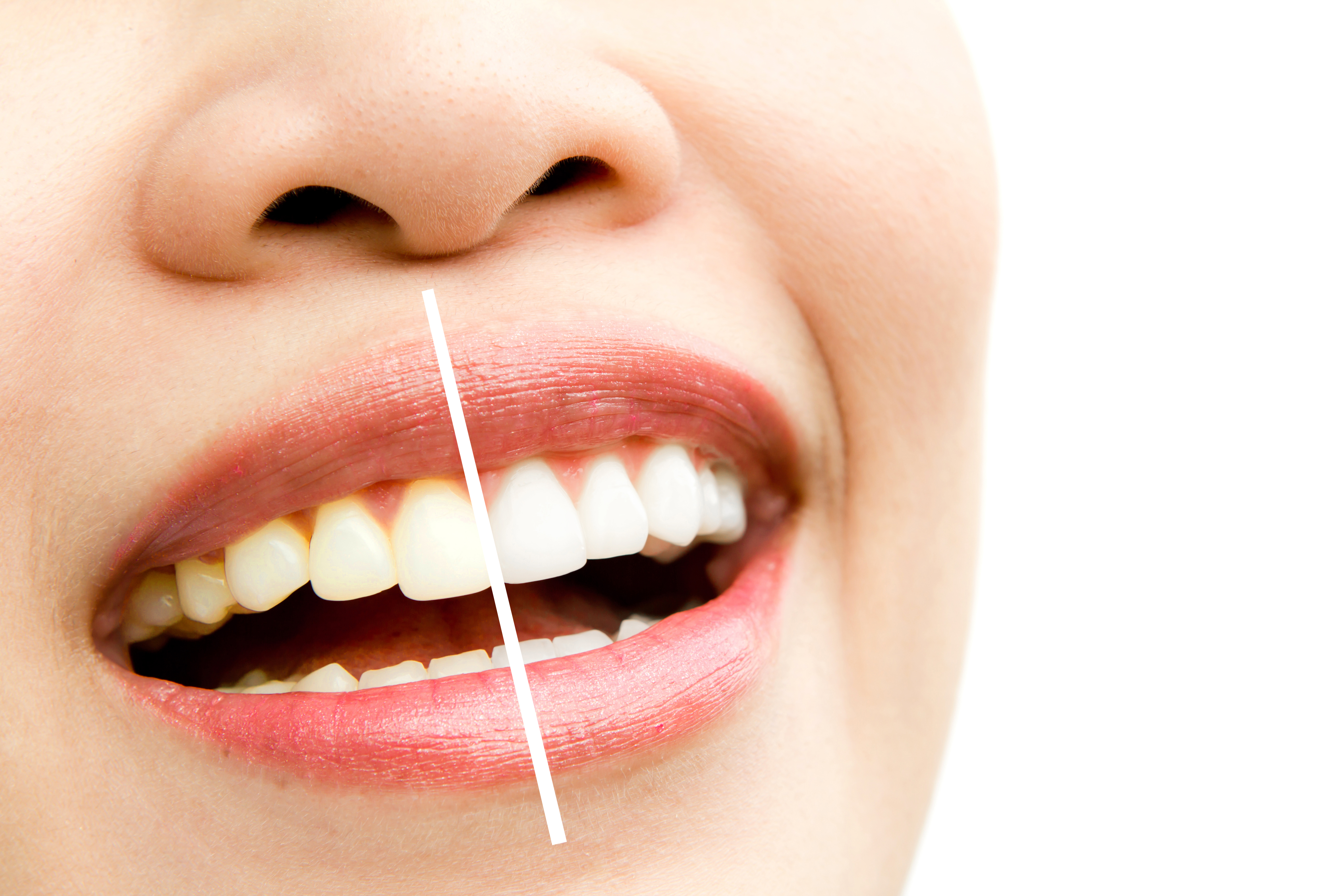 How to keep teeth whiter for longer