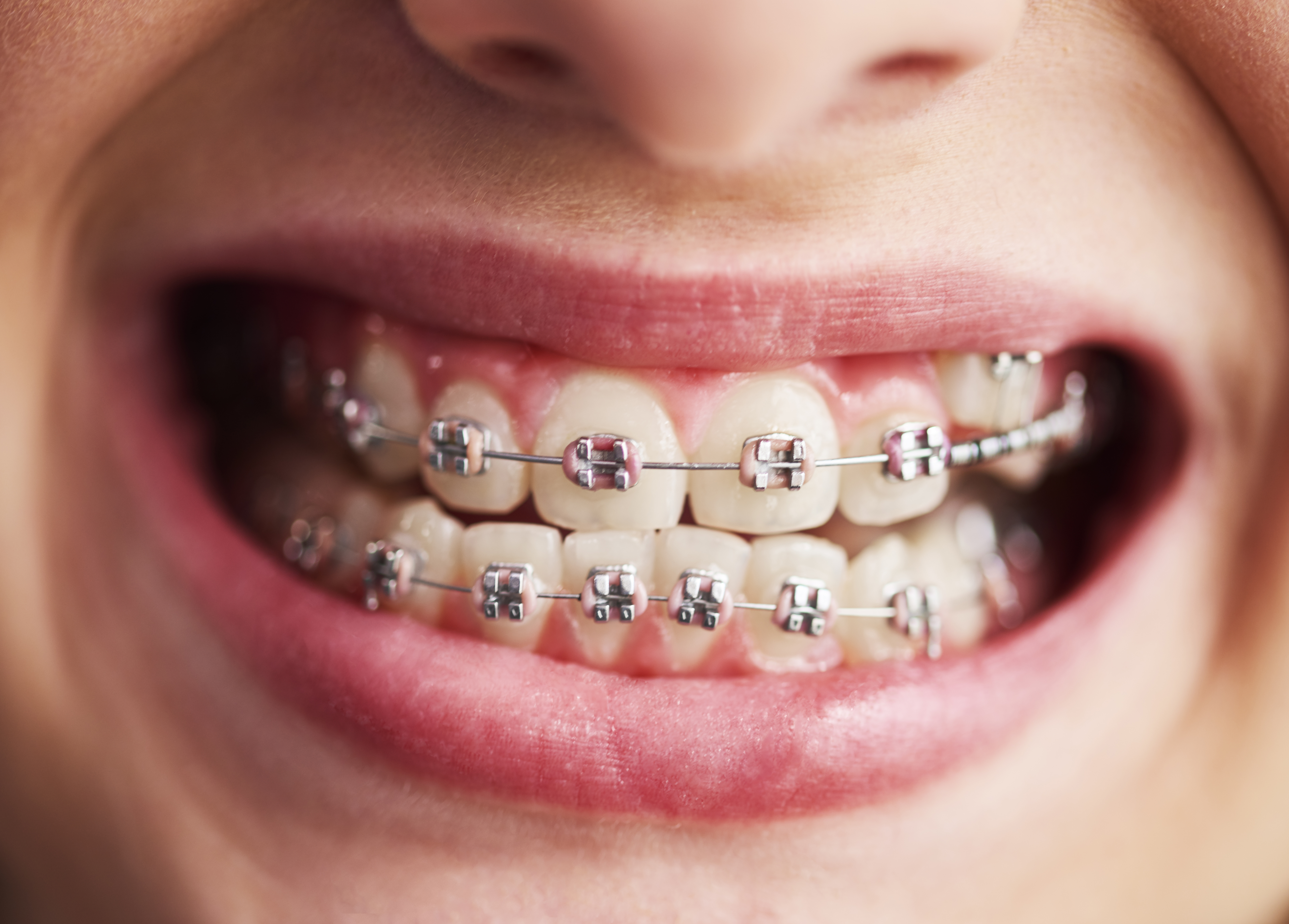 Braces case for crowded teeth
