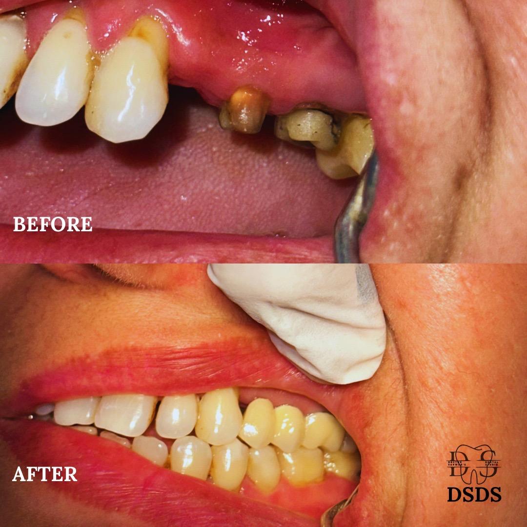 Single tooth implant case