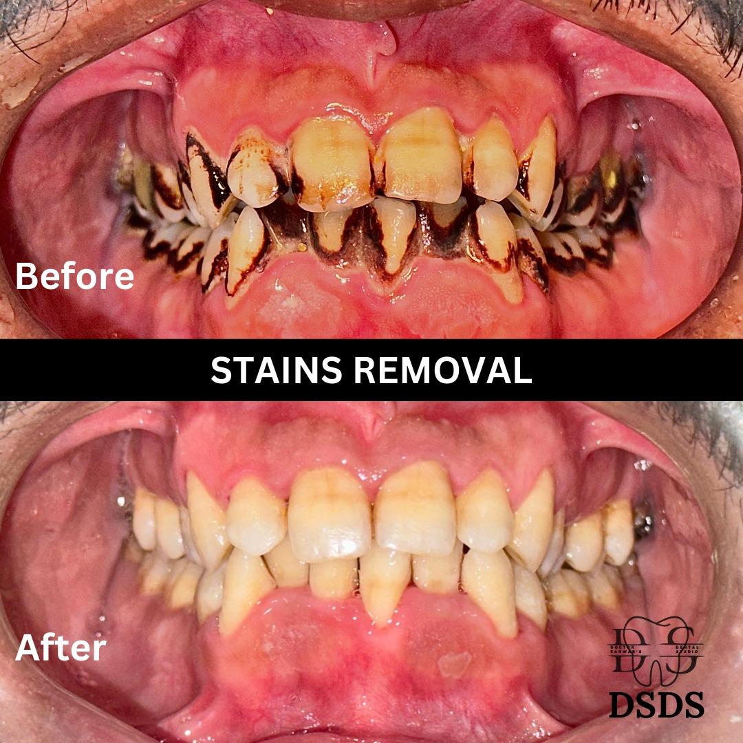 Gum health and cleaning case