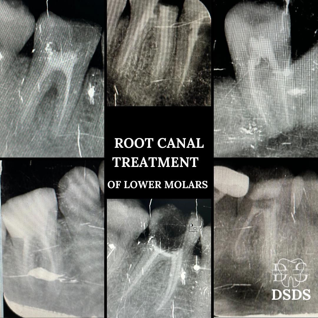 Root canal treatment case