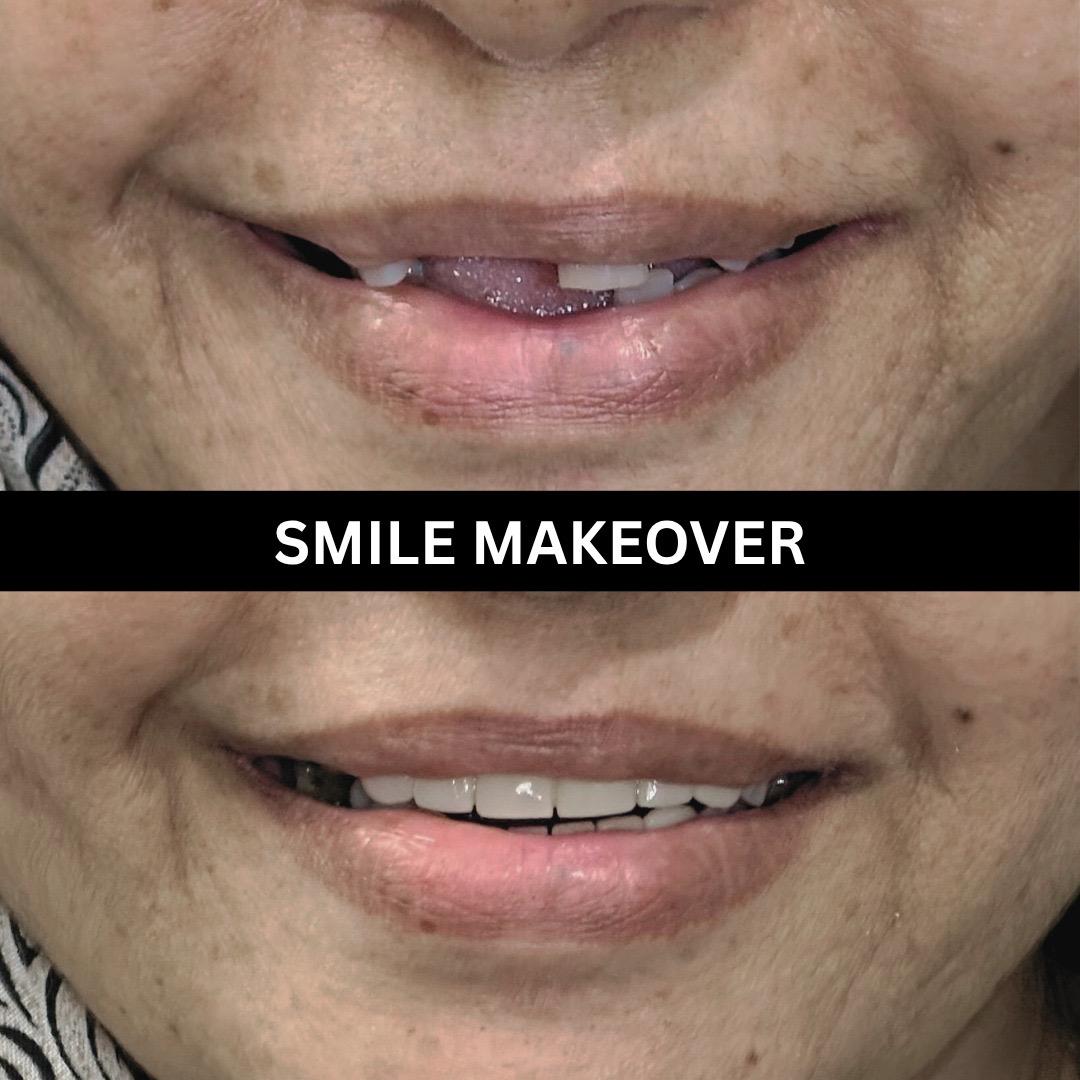 Veneers smile makeover case
