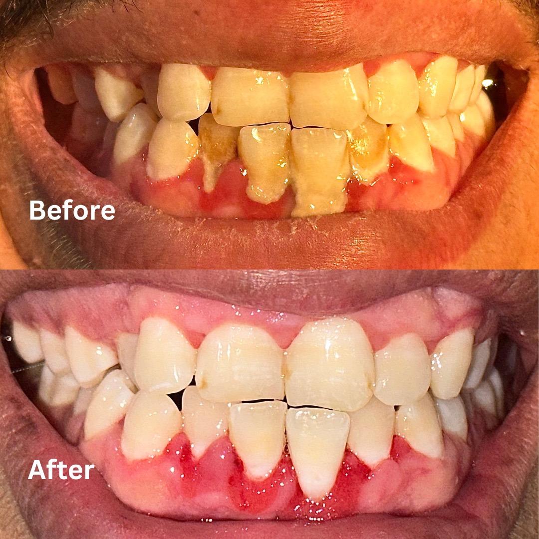 Scaling and polishing case