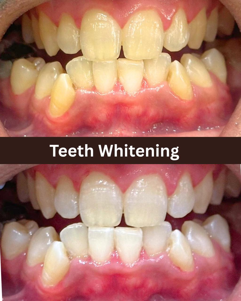 Teeth whitening case