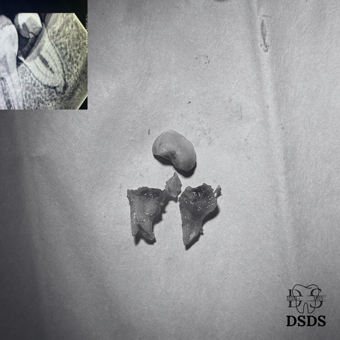 Dental crown fracture case