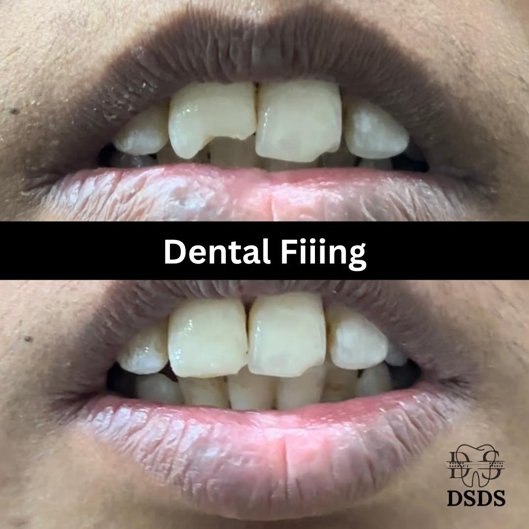 Dental bridge gap replacement case