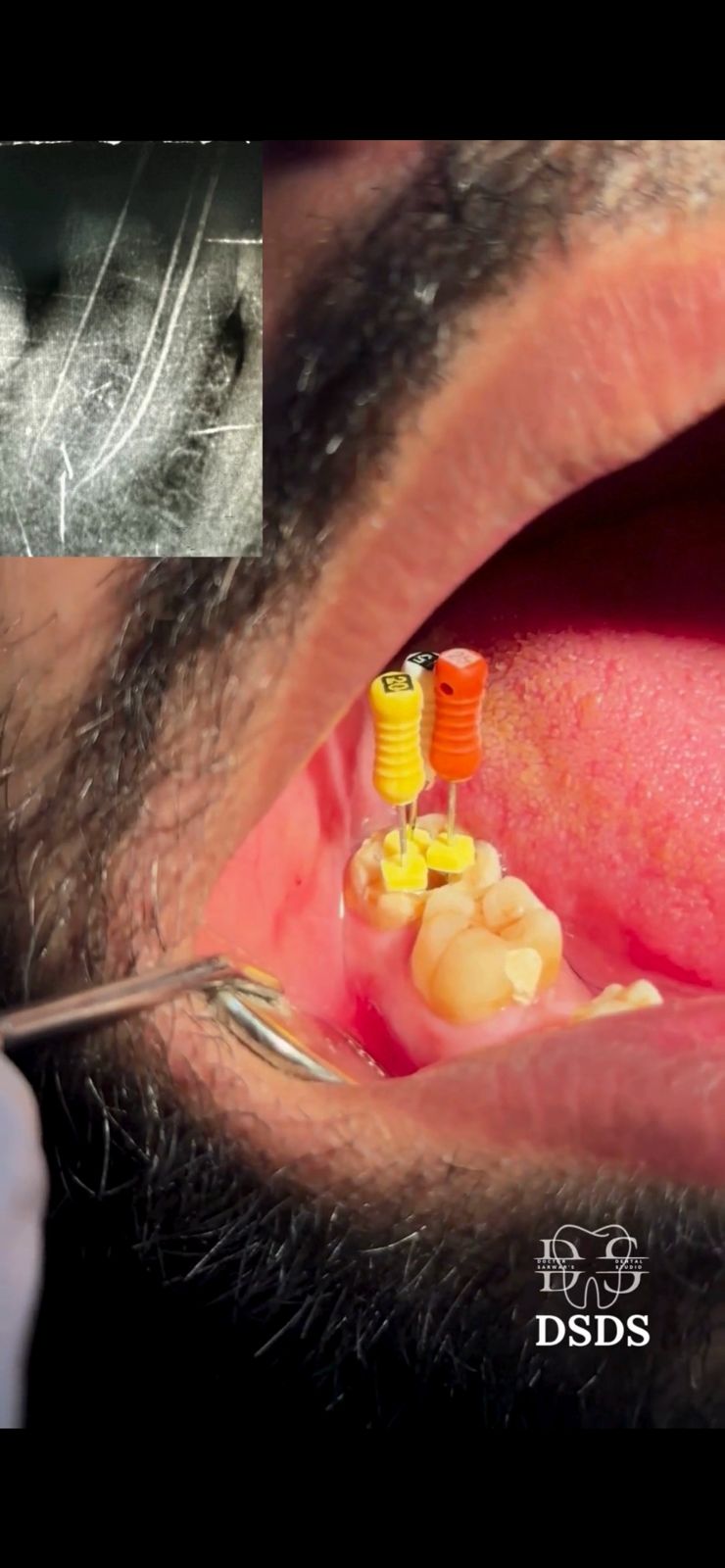 Early fillings treatment case