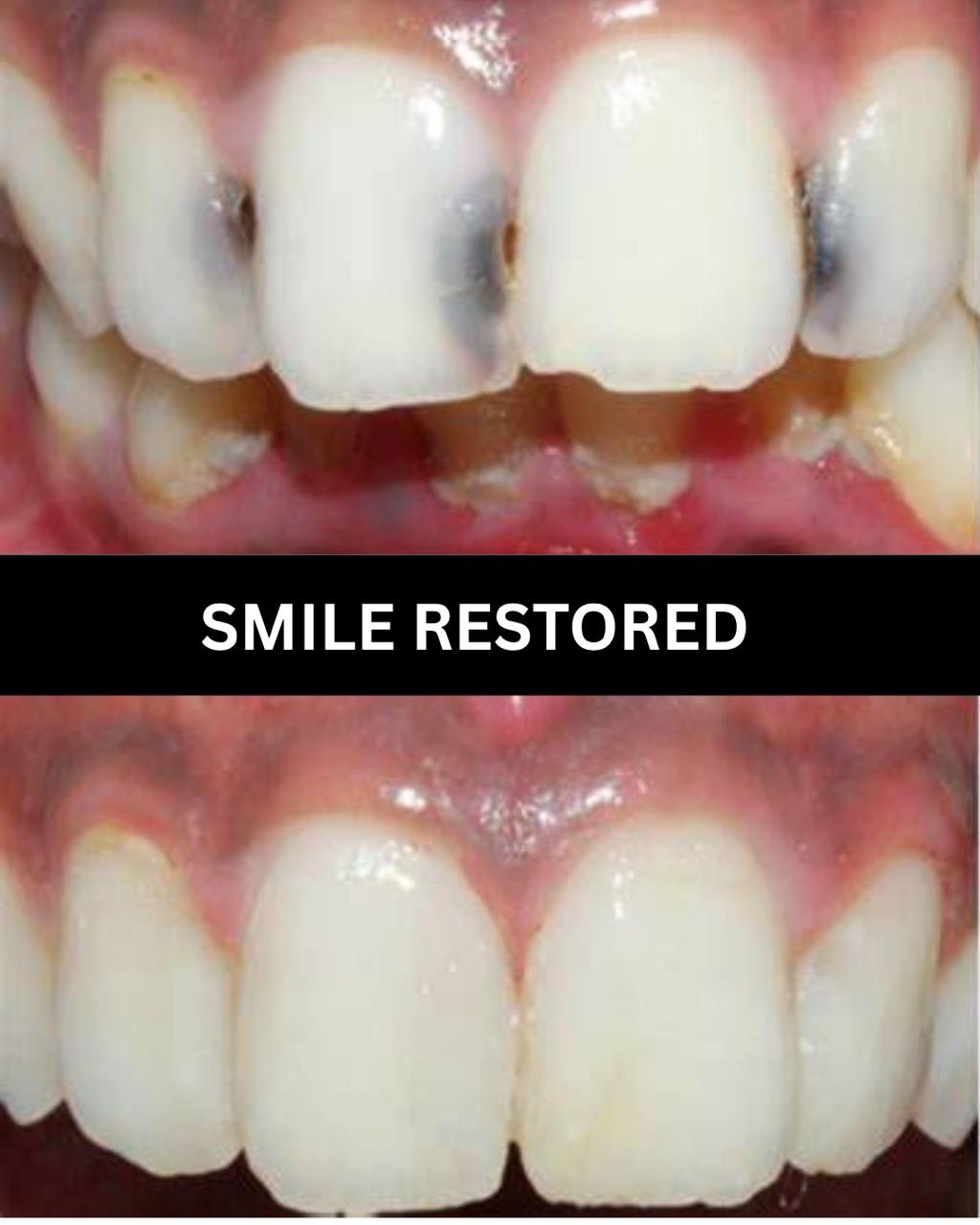 Combined whitening and veneers case