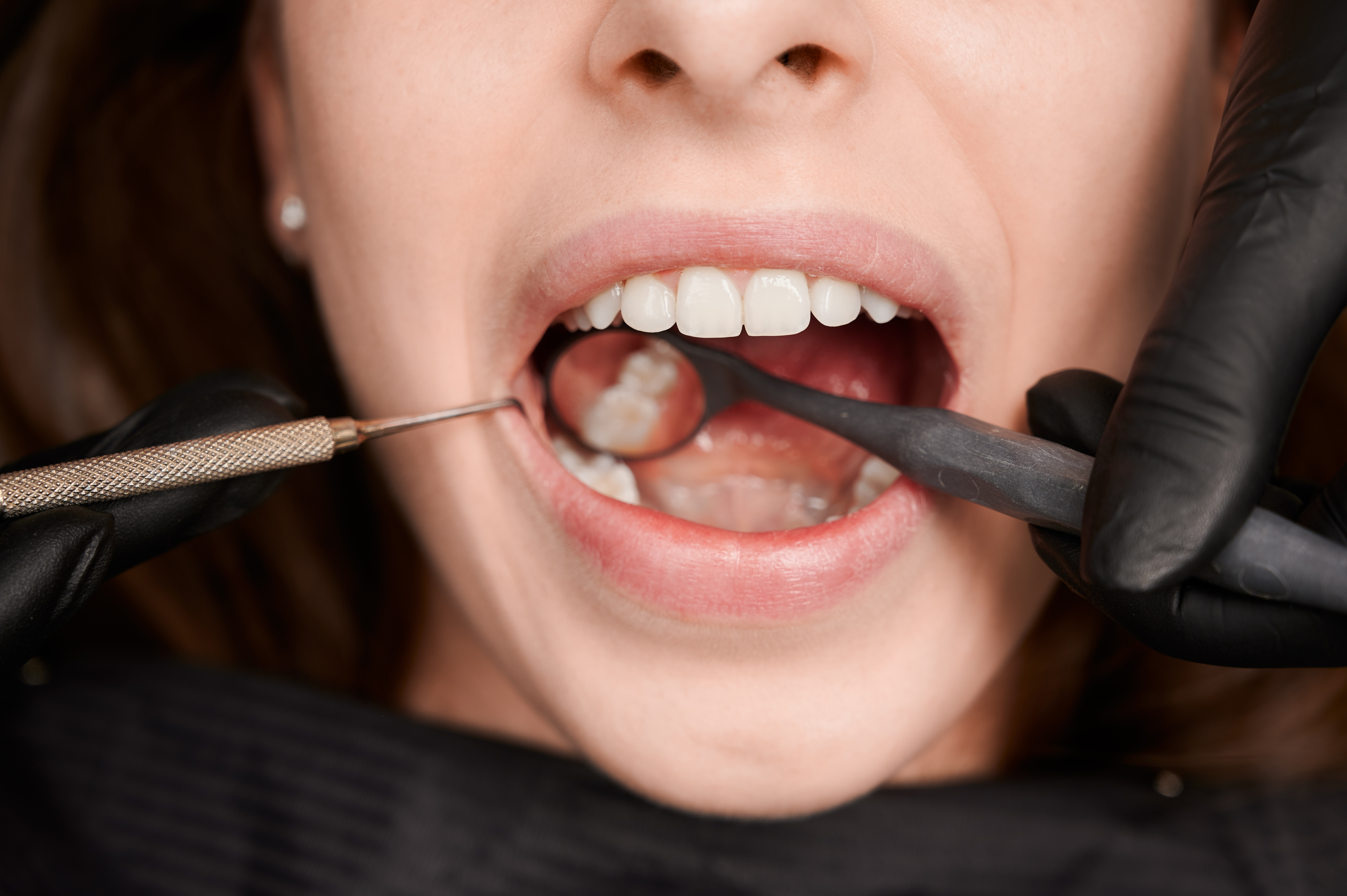Dental fillings in Lahore at Dental Specialists